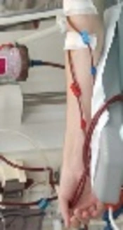 The Prevalence of HIV, HCV, and HBV Among Hemodialysis Patients Attending Duhok Hemodialysis Center